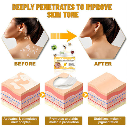 Seurico™ Bee Venom Treatment Cream for Vitiligo