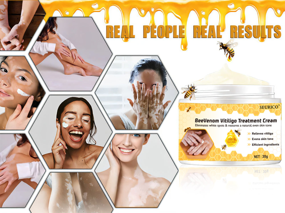 Seurico™ Bee Venom Treatment Cream for Vitiligo