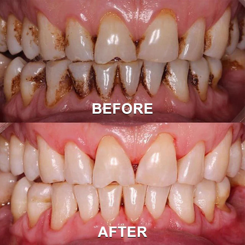✅Seurico™ Gum Repair & Oral Health Powder (CE Certified for Periodontitis, Mouth Sores, and Gum Recession)