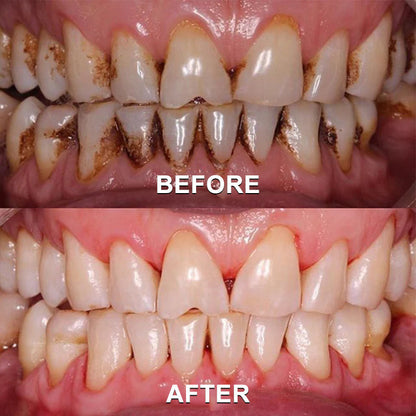 ✅Seurico™ Gum Repair & Oral Health Powder (CE Certified for Periodontitis, Mouth Sores, and Gum Recession)