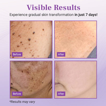 Seurico™ DermaClear Mole and Dark Spot Removal Bio-Gel