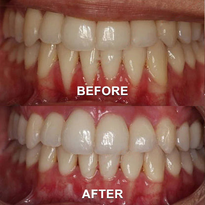 ✅Seurico™ Gum Repair & Oral Health Powder (CE Certified for Periodontitis, Mouth Sores, and Gum Recession)