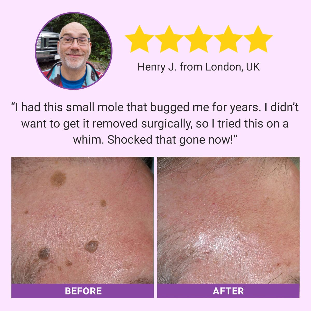 Seurico™ DermaClear Mole and Dark Spot Removal Bio-Gel