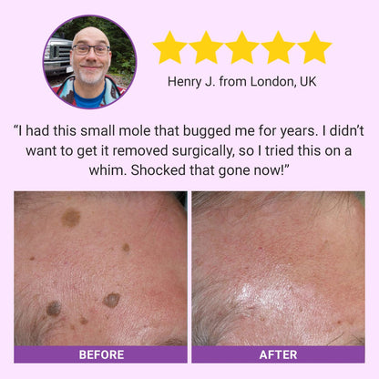 Seurico™ DermaClear Mole and Dark Spot Removal Bio-Gel